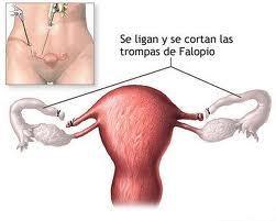 Anticonceptivos definitivos: ligadura de trompas