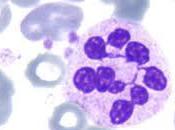 anemia perniciosa