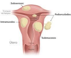 Las causas del mioma uterino