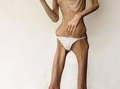 Detecte precozmente adolescente inicia trastorno conducta alimentaria