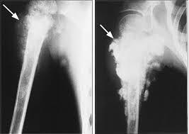 13 DE JUNIO DÍA MUNDIAL DEL OSTEOSARCOMA O CÁNCER DE HUESOS