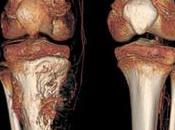 junio mundial osteosarcoma cáncer huesos