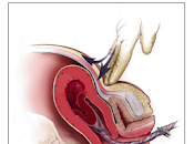 Encuentra Nuevo Indicio para Tratar Retención Placentaria
