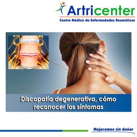 Artricenter: Discopatía degenerativa, cómo reconocer los síntomas Artricenter: Discopatía degenerativa, cómo reconocer los síntomas
