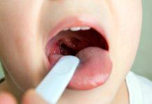 ¿Puede tener estreptococo en la garganta después de la amigdalectomía?
