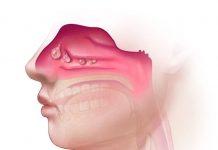 Pólipos nasales y dolor nasal