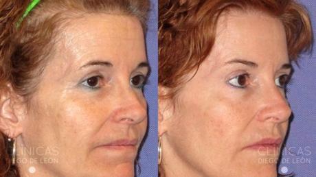 LA GRAN DUDA DEL BÓTOX: ¿SÍ O NO?