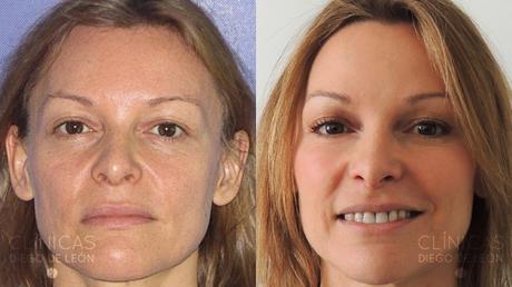 LA GRAN DUDA DEL BÓTOX: ¿SÍ O NO?