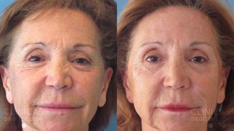 LA GRAN DUDA DEL BÓTOX: ¿SÍ O NO?