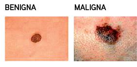 ¿Como identificar un lunar peligroso?