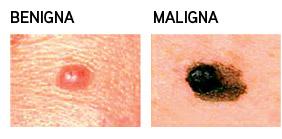 ¿Como identificar un lunar peligroso?