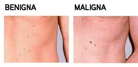 ¿Como identificar un lunar peligroso?