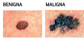 ¿Como identificar un lunar peligroso?