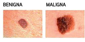 ¿Como identificar un lunar peligroso?