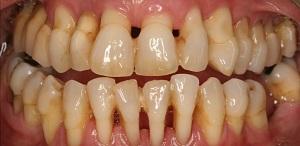 PERIODONTITIS O PIORREA – Qué es y cómo prevenir esta enfermedad Periodontitis o Piorrea qué es y como prevenir esta enfermedad pediodontal