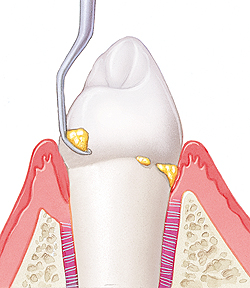PERIODONTITIS O PIORREA – Qué es y cómo prevenir esta enfermedad Periodontitis o Piorrea qué es y como prevenir esta enfermedad pediodontal