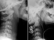 Detectar Factores Riesgo Cervical reduce Tomografías