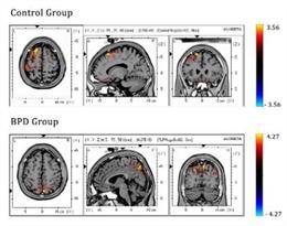 Las personas con trastorno límite de la personalidad activan regiones cerebrales distintas para controlar sus impulsos