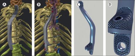 Impresión 3D de implantes y prótesis: estado del arte