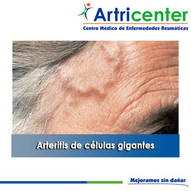 Artricenter: Arteritis de células gigantes