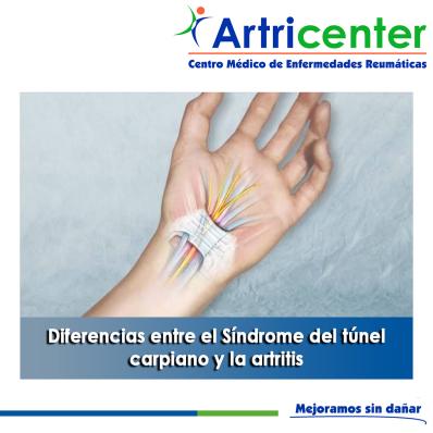 Artricenter: Diferencias entre el Síndrome del túnel carpiano y la artritis.