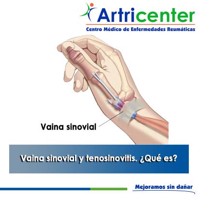 Artricenter: Vaina sinovial y tenosinovitis. ¿Qué es?