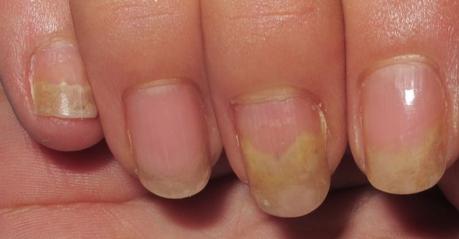 Cuáles son las causas de las uñas amarillas