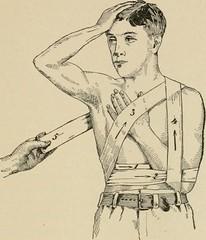 velpeau vendaje velpeau vendaje