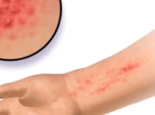Consejos prácticos para controlar óptimamente dermatitis medio hábitos higiene, alimenticios mentales
