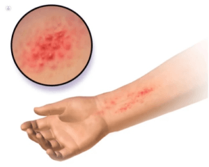 Consejos prácticos para controlar óptimamente la dermatitis por medio de hábitos de higiene, hábitos alimenticios y hábitos mentales