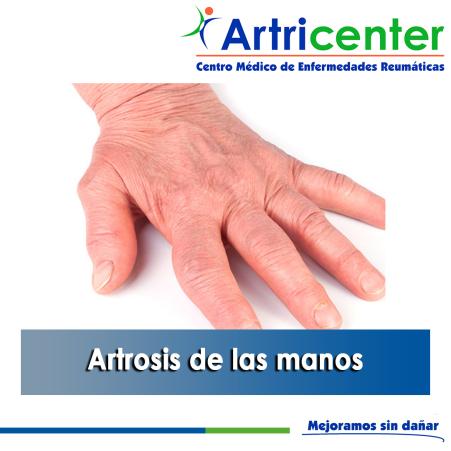 Artricenter: Artrosis de las manos