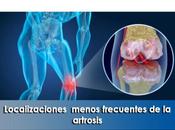 Artricenter: Localizaciones menos frecuentes artrosis.