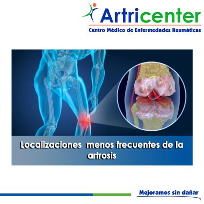 Artricenter: Localizaciones  menos frecuentes de la artrosis.
