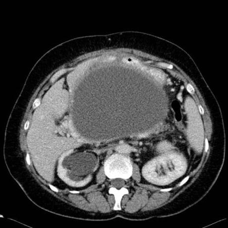 PSEUDOQUISTE PANCREATICO PSEUDOQUISTE PANCREATICO