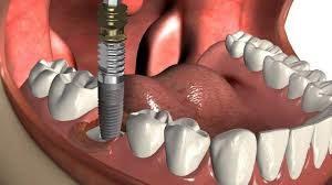 Implantes dentales, que debemos tener en cuenta, Dental Denche implantes dentales en Madrid Dental Denche implantes en madrid