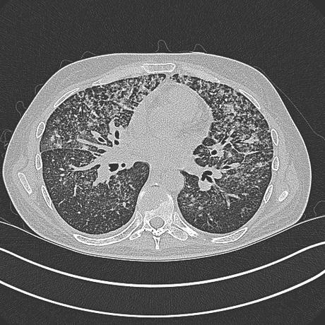 TUBERCULOSIS PULMONAR RESUMEN PARA ESTUDIANTE