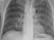 Tuberculosis pulmonar resumen para estudiante