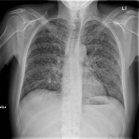 TUBERCULOSIS PULMONAR RESUMEN PARA ESTUDIANTE