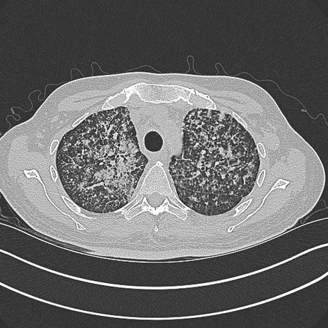 TUBERCULOSIS PULMONAR RESUMEN PARA ESTUDIANTE