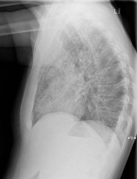 TUBERCULOSIS PULMONAR RESUMEN PARA ESTUDIANTE