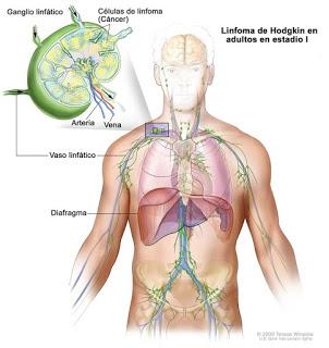 LINFOMA - EL CÁNCER DEL TEJIDO LINFÁTICO ES MÁS COMÚN EN EDADES DE 15 A 35 Y DE 50 A 70 AÑOS