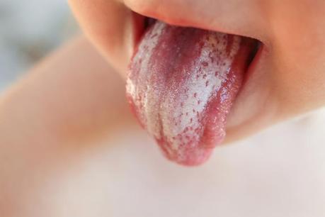 Candidiasis: infección en la boca de bebés y niños