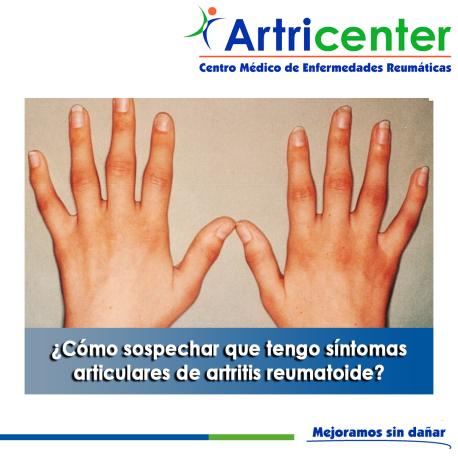 Artricenter: ¿Cómo sospechar que tengo síntomas articulares de artritis reumatoide? Artricenter: ¿Cómo sospechar que tengo síntomas articulares de artritis reumatoide?
