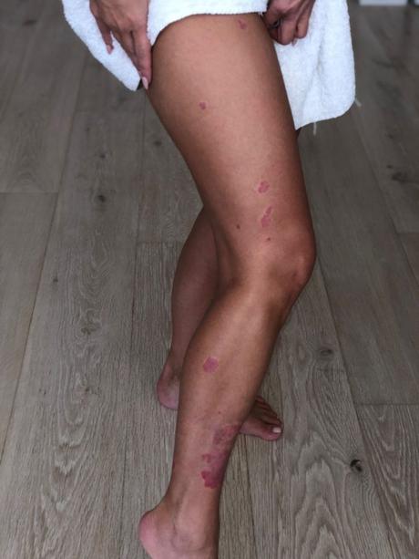 Kim Kardashian mostró fotos de su piel afectada por la psoriasis