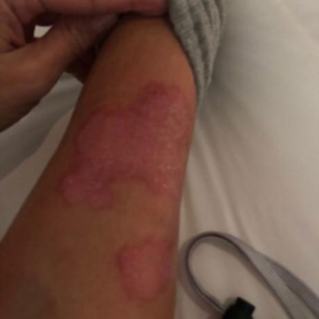 Kim Kardashian mostró fotos de su piel afectada por la psoriasis