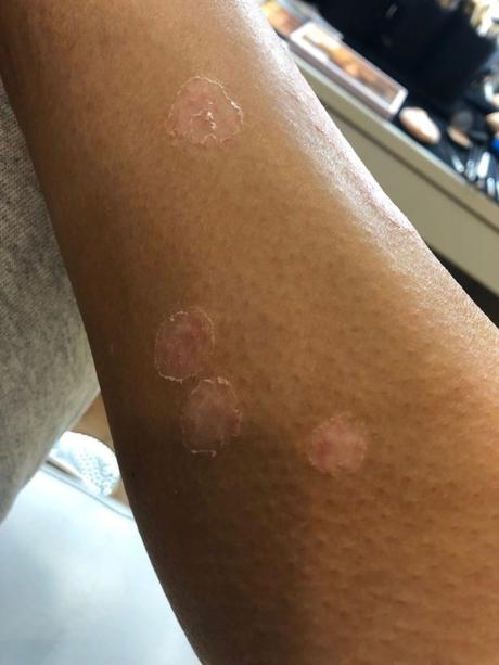 Kim Kardashian mostró fotos de su piel afectada por la psoriasis