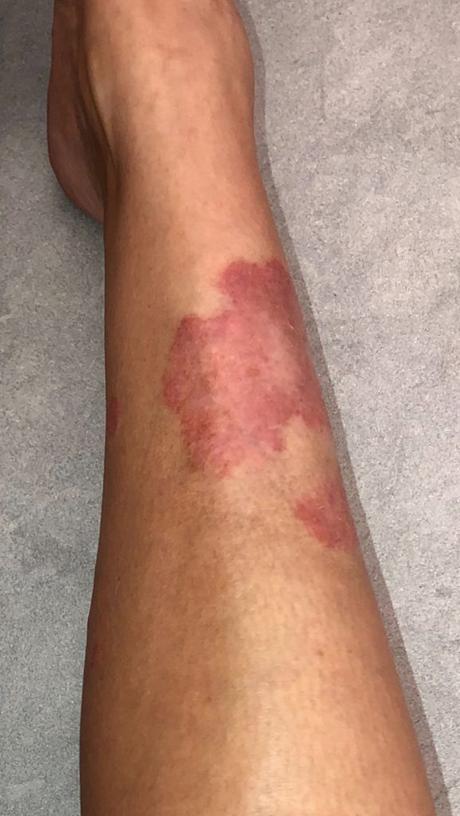 Kim Kardashian mostró fotos de su piel afectada por la psoriasis