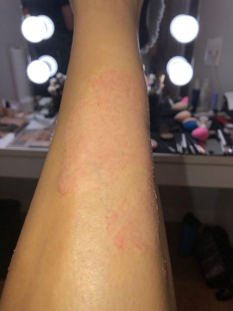 Kim Kardashian mostró fotos de su piel afectada por la psoriasis