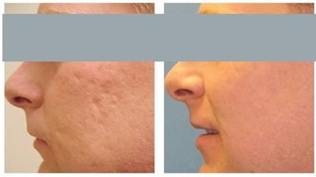 EL MEJOR TRATAMIENTO DE UNA CICATRIZ: 10 RECOMENDACIONES PARA ELIMINAR LAS CICATRICES, ESPECIALMENTE LAS DE ACNE EL MEJOR TRATAMIENTO DE UNA CICATRIZ: 10 RECOMENDACIONES PARA ELIMINAR LAS CICATRICES, ESPECIALMENTE LAS DE ACNE