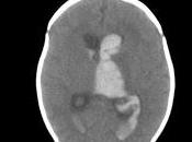 Posible Tratamiento Médico Hidrocefalia